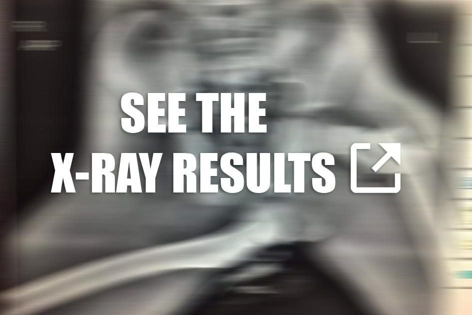 This xray shows why you should never rest your feet on the dashboard