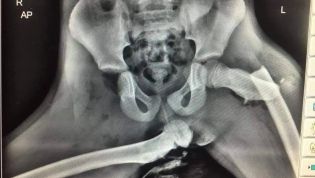 This x-ray shows why you should never rest your feet on the dashboard