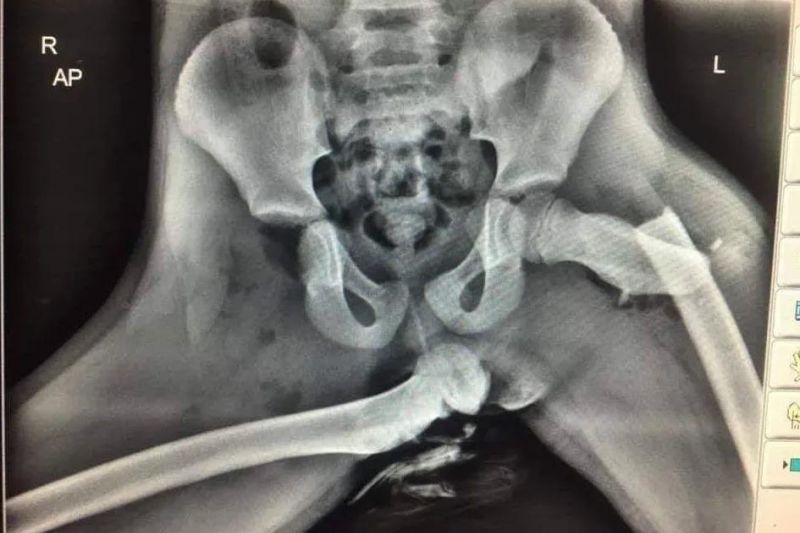 This x-ray shows why you should never rest your feet on the dashboard